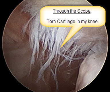130113 Knee Surgery